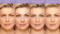 Botox (Botulinum Toxin) injections before & afters